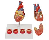 动脉粥羊硬化+血栓模型（2部件）