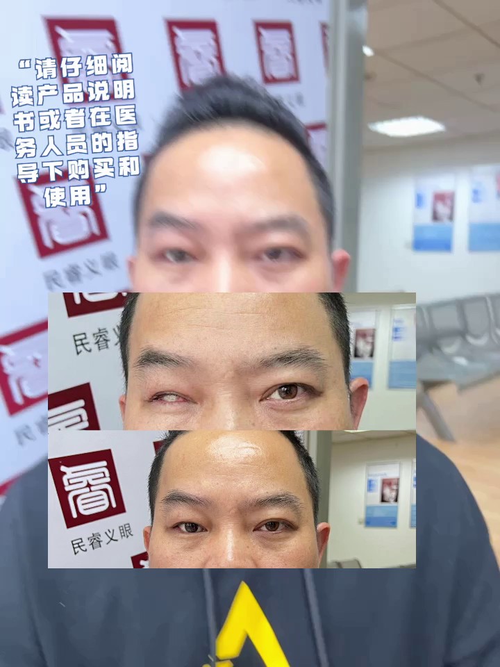重庆人工超薄义眼片片,超薄义眼片