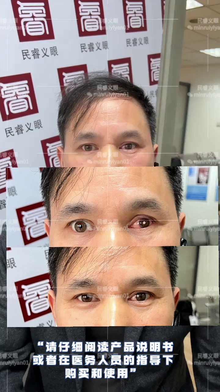 上海人工超薄义眼片清洗,超薄义眼片