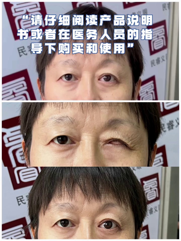 海南摘除超薄义眼片需要多久,超薄义眼片