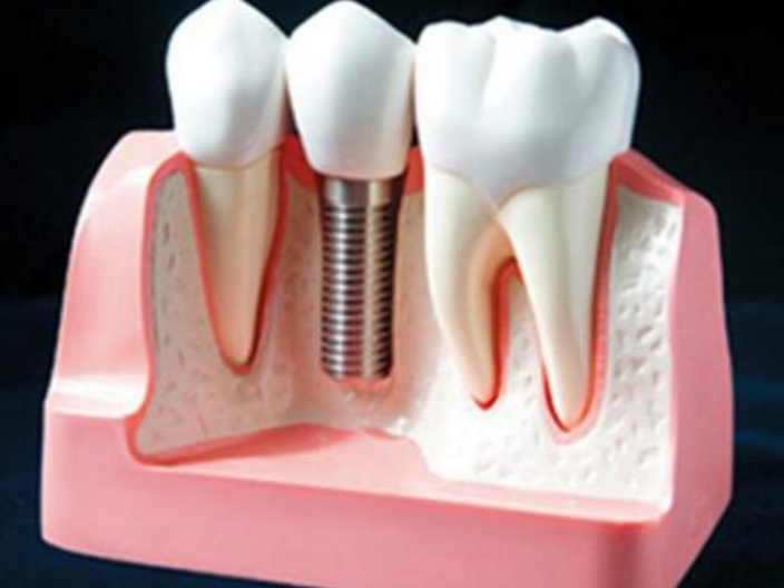 廣東專業的自體牙骨粉值得推薦,自體牙骨粉