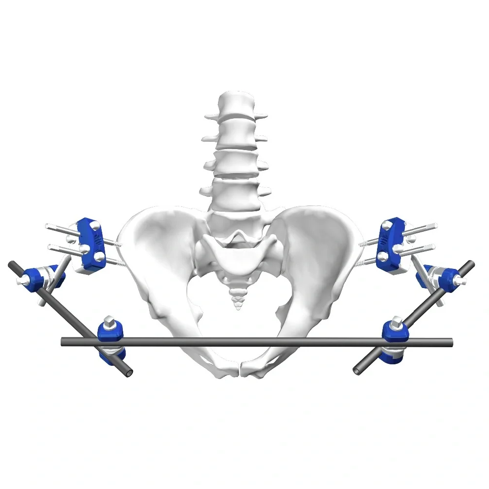 Pelvis And Hip External Fixator Pelvis Price/Supplier-Inature