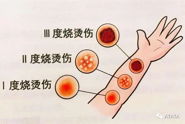 这四类烧伤如何自救?如何在烧伤后进行正确的现场急救?-爱氏(深圳)医药有限公司