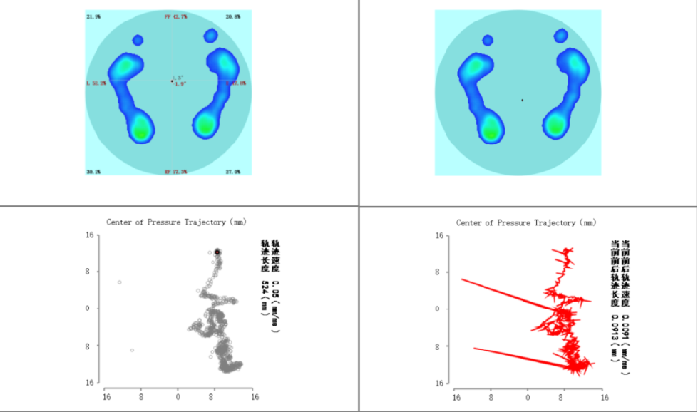 足底受力分析