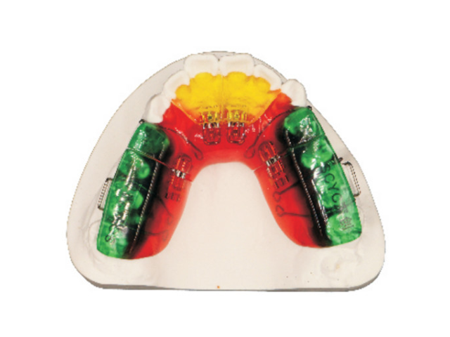 四川MSE固定扩弓器要戴多久 深圳市深创义齿技术供应