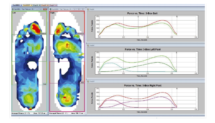 步态分析丨数据科学带来的健康益处_郑小姐