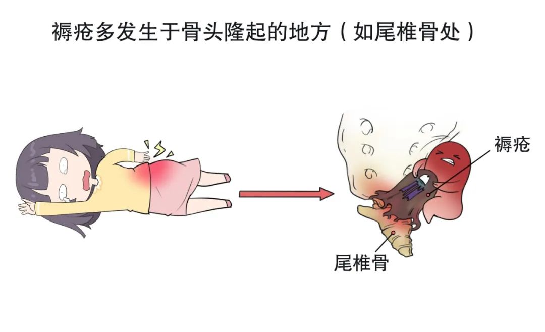 关于褥疮护理那些事