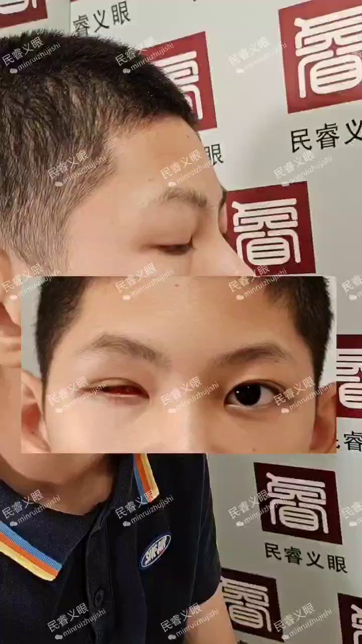 湖北民睿义眼清洗,义眼