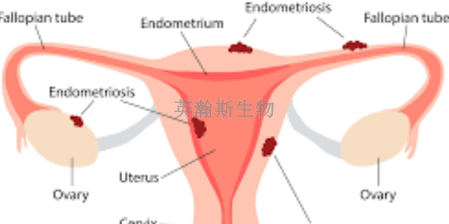 甘肃推荐的子宫内膜异位症模型有哪些