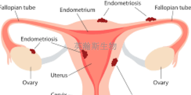 廣東哪里有子宮內(nèi)膜異位癥模型是哪家,子宮內(nèi)膜異位癥模型