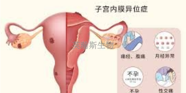 重庆推荐的子宫内膜异位症模型有哪些,子宫内膜异位症模型
