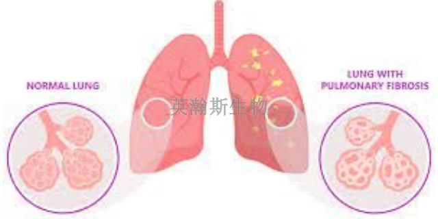 云南真实的肺纤维化模型有哪些