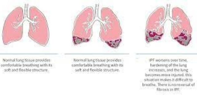 福建真實的肺纖維化模型有哪家 歡迎來電 南京英瀚斯生物科技供應(yīng)