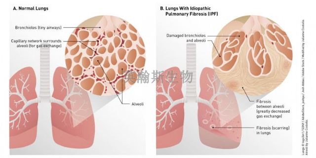 内蒙古比较好的肺纤维化模型如何构建