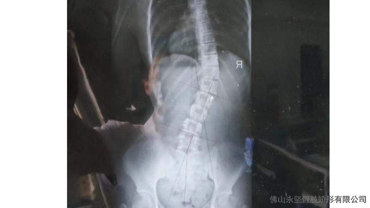 珠海15岁脊柱侧弯怎么引起 欢迎咨询 佛山市永坚假肢矫形器供应