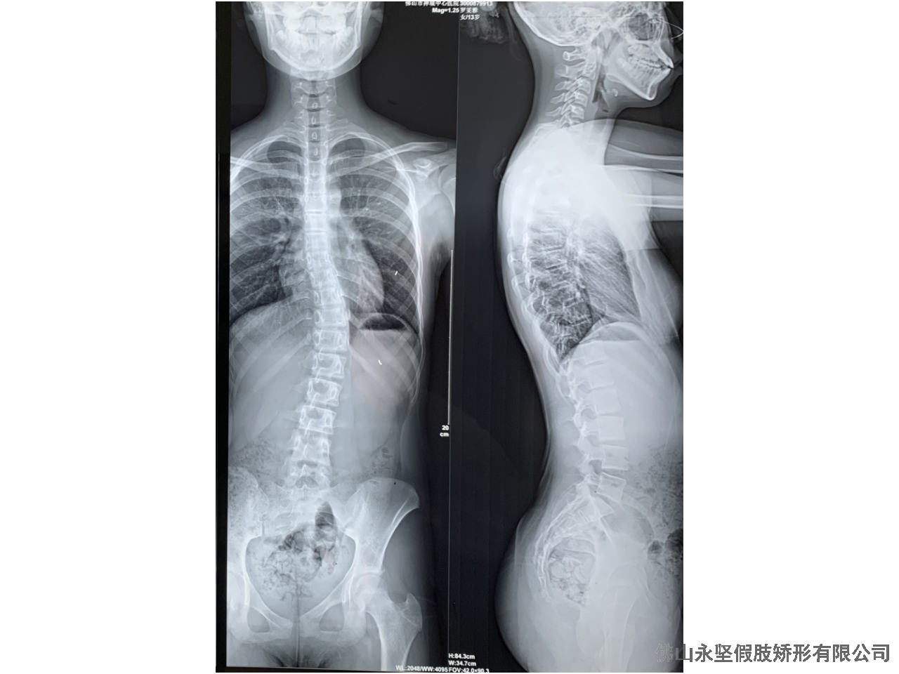 清远脊柱侧弯的治疗方法 客户至上 佛山市永坚假肢矫形器供应