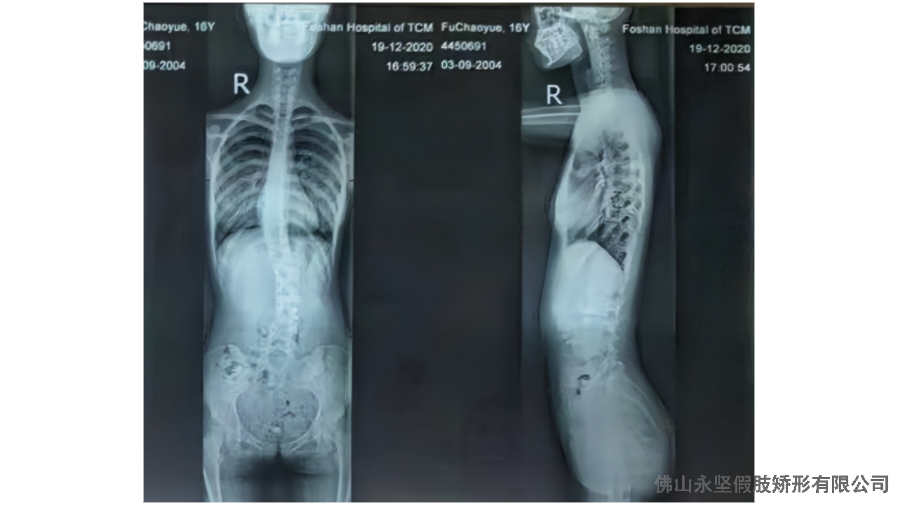 佛山3D扫描定制脊柱侧弯 推荐咨询 佛山市永坚假肢矫形器供应