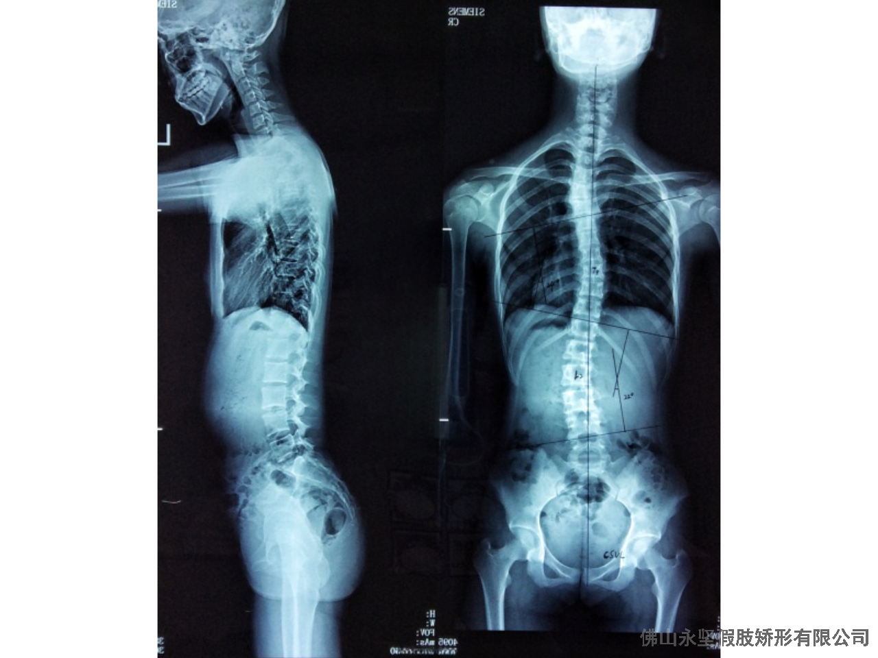 珠海15岁脊柱侧弯怎么办 欢迎来电 佛山市永坚假肢矫形器供应