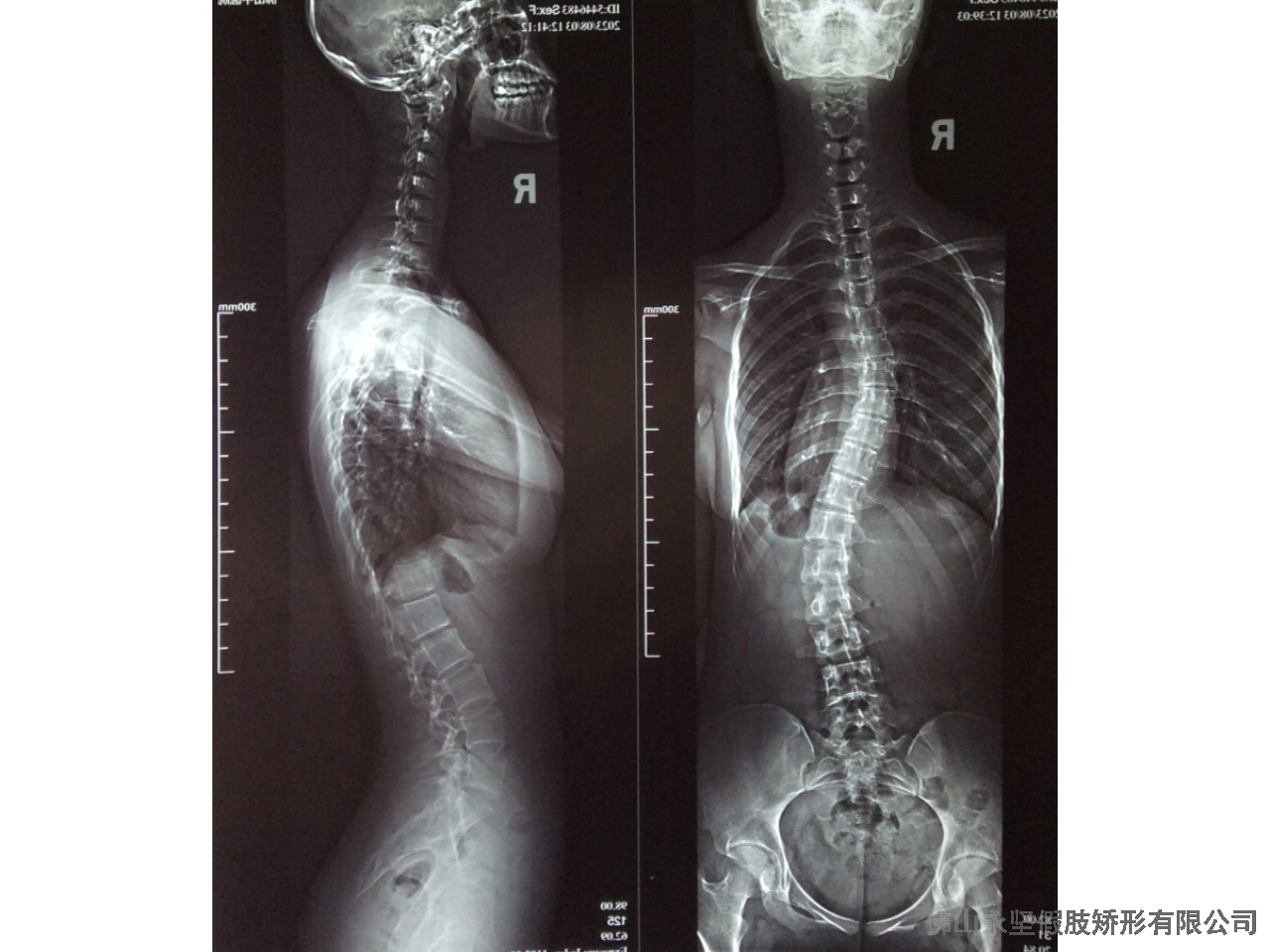 广东轻度胸椎脊柱侧弯是怎么造成 推荐咨询 佛山市永坚假肢矫形器供应