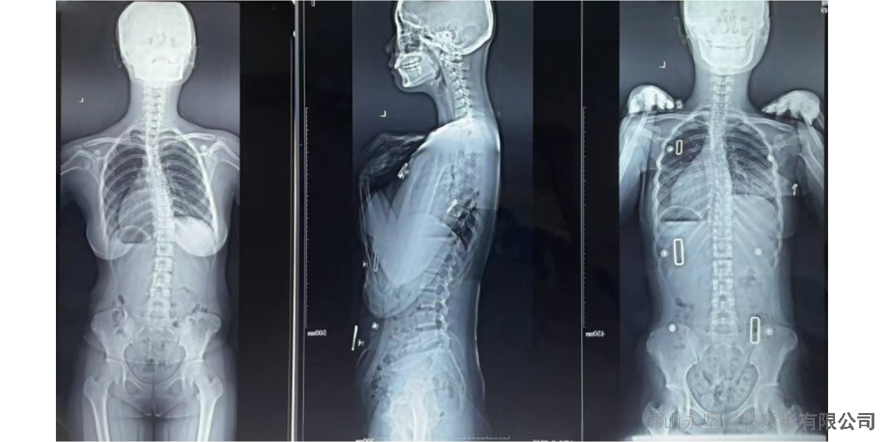 东莞3D扫描定制脊柱侧弯支具 服务为先 佛山市永坚假肢矫形器供应